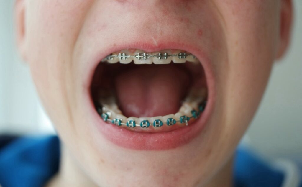 Le réflexe nauséeux et dentisterie, mieux comprendre pour mieux agir Dental Education